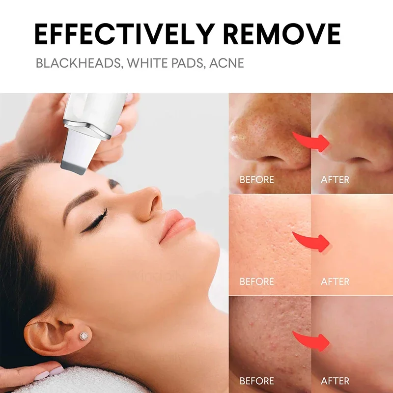 Rosto purificador da pele limpeza profunda vibração massagem limpador facial pá espátula peeling removedor de cravo poros ferramenta de cuidados com a pele