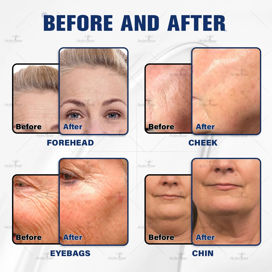 Perfectlaser 4 in 1 EMS マシンフェイスリフティング筋肉彫刻しわ除去プロフェッショナル無痛脂肪燃焼装置