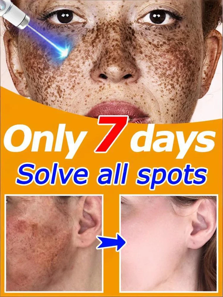 

AʟɪExᴘʀᴇss ʙᴇsᴛ-sᴇʟʟɪɴɢ ʟᴀsᴇʀ ғʀᴇᴄᴋʟᴇ ʀᴇᴍᴏᴠᴀʟ ᴘᴇɴ, sᴜɪᴛᴀʙʟᴇ ғᴏʀ ʙᴏᴛʜ ʜᴏᴍᴇ ᴀɴᴅ ᴘʀᴏғᴇssɪᴏɴᴀʟ sᴀʟᴏɴ ᴜsᴇ, ᴀ ᴛᴏᴏʟ ғᴏʀ ʀᴇᴍᴏᴠɪɴɢ ᴛᴀᴛᴛᴏᴏ