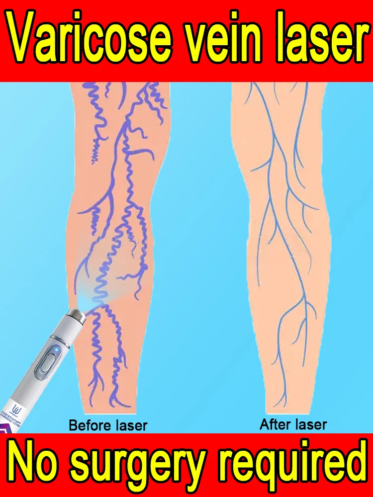 

Varicose Veins Treatment: Varicose Veins Laser Pen