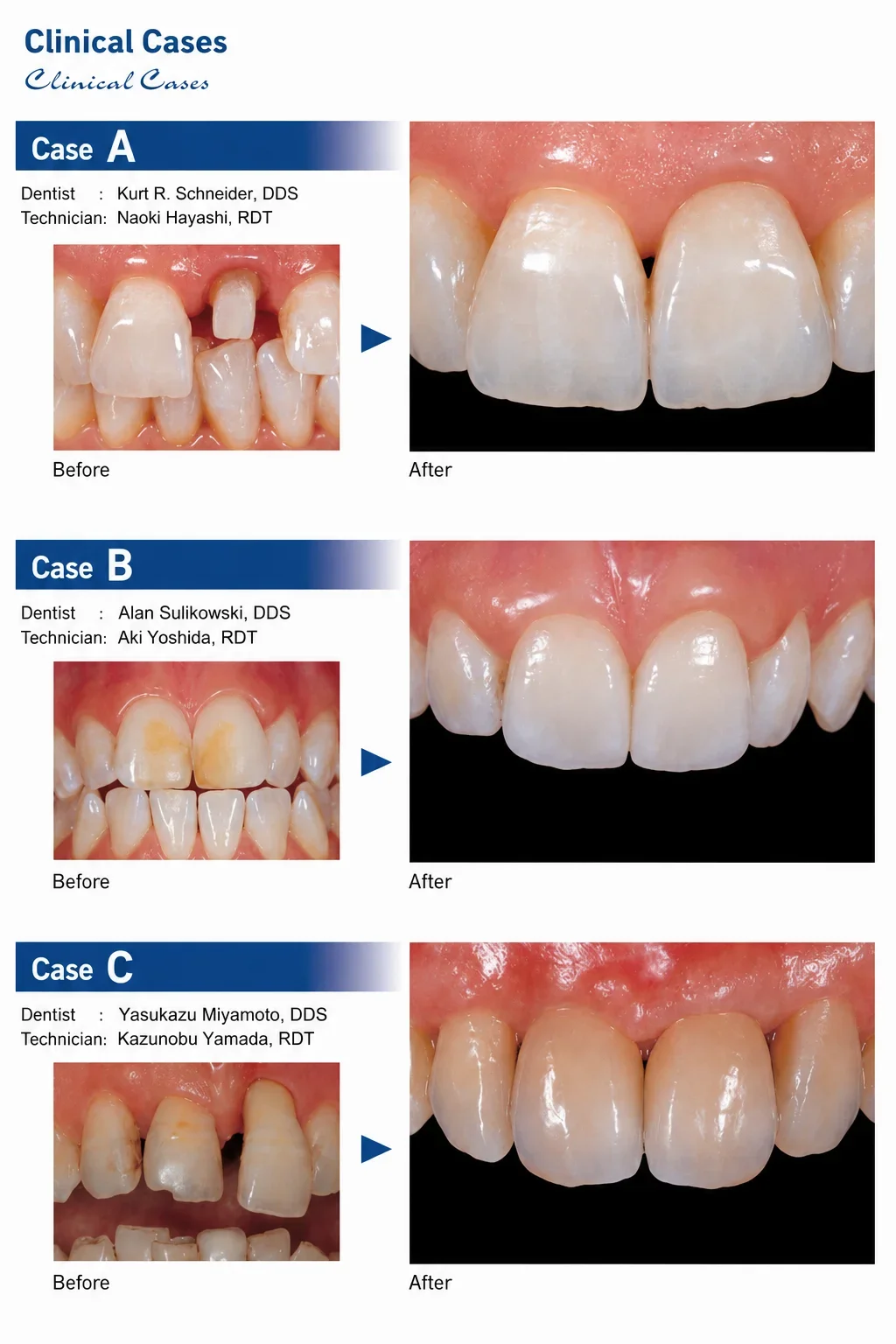 Noritake EX-3 Super Body Porcelain Powder 50g Multi Shades A1B A2B E2 TX PFM Crown Bridge Ceramic Restoration Material