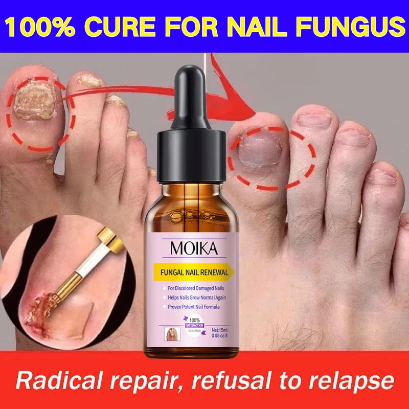 

Fungal Nail Treatment Serum Foot Nail Fungus Removal Repair Gel Anti Infection Paronychia Onychomycosis Foot Nails Care Essence