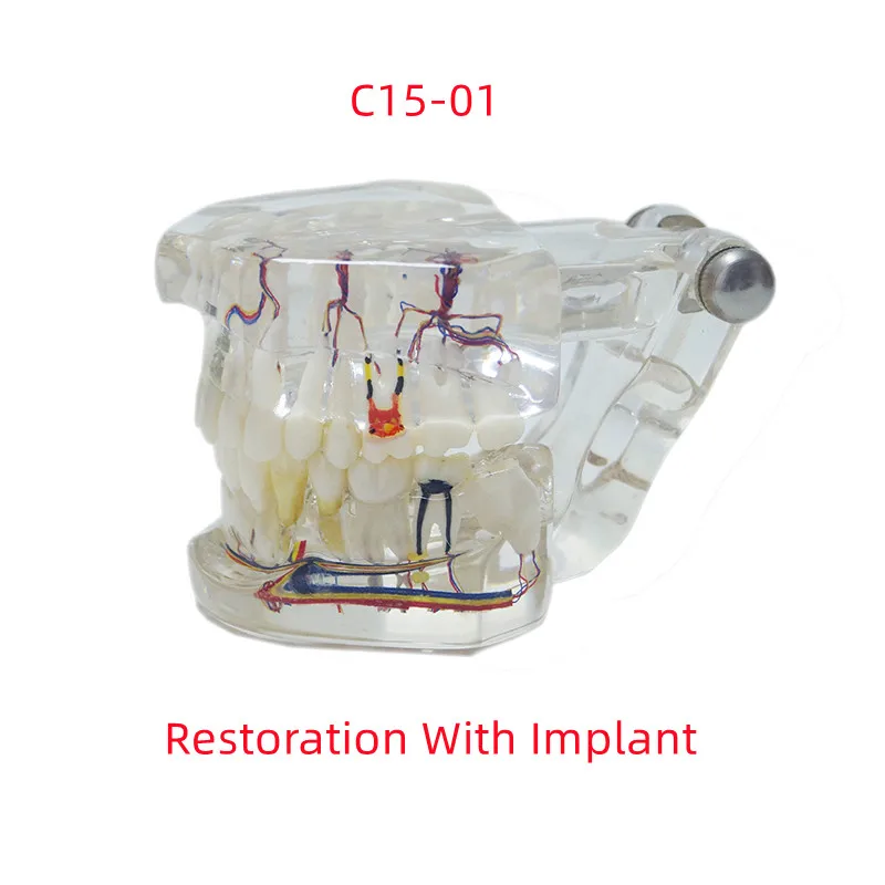 Dental Teaching Model Restoration With Implant Pathological Model With Nerve C15-01 Display Planting Bridge Dentist Tool