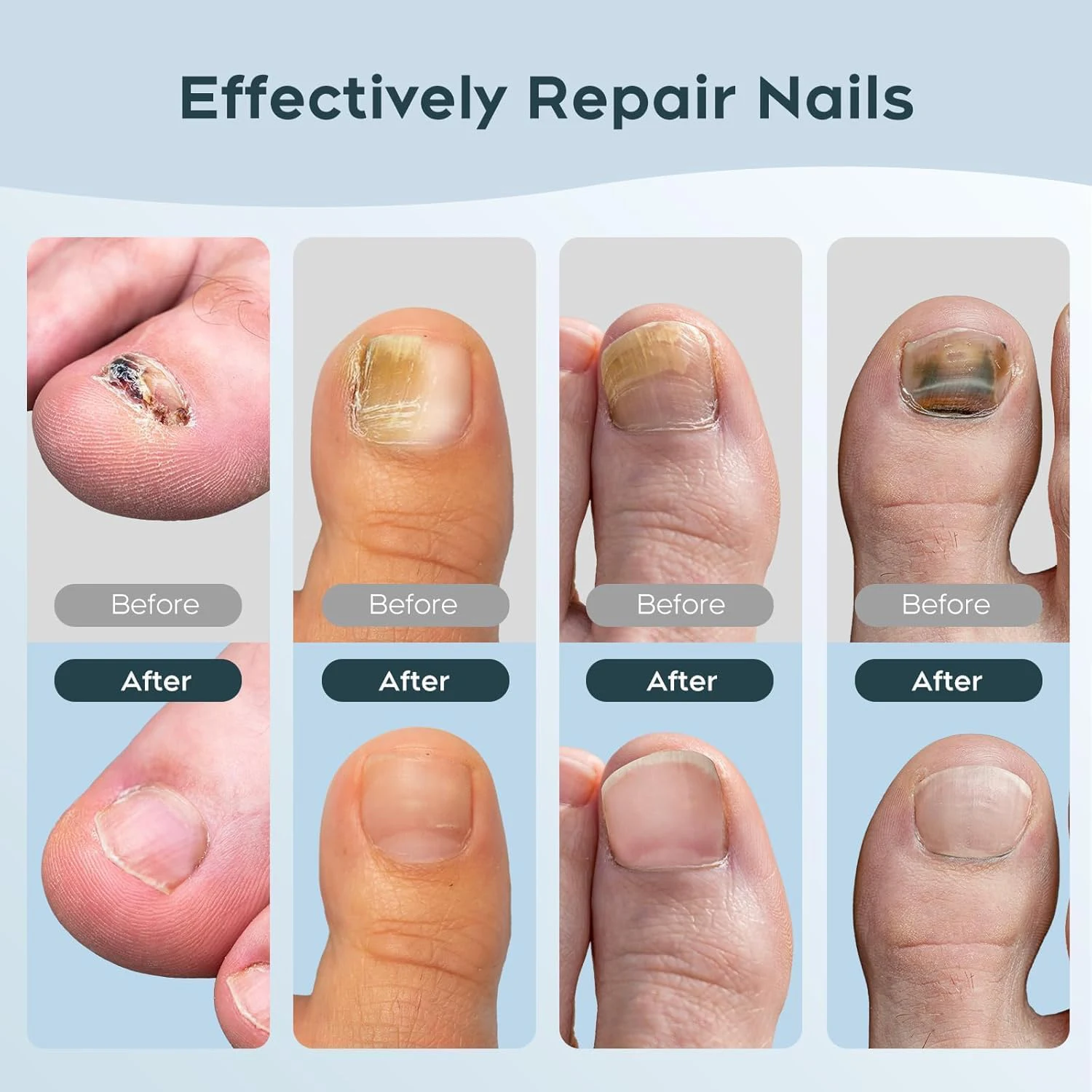 جهاز ليزر للأظافر الفطرية المنزلية أظافر القدم أظافر مضاد للعدوى الفطري الداحس فطار أظافر نام