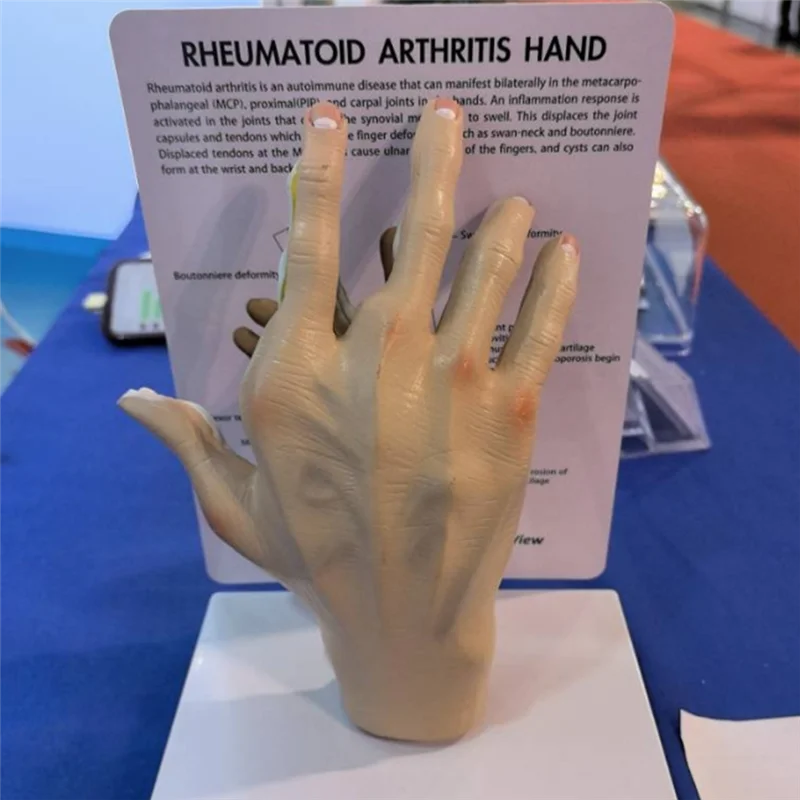 

Osteoarthritis Hand Model, Model Of Hand Pathology, Human Anatomy And Physiology Replica, 's Office Anatomy Model