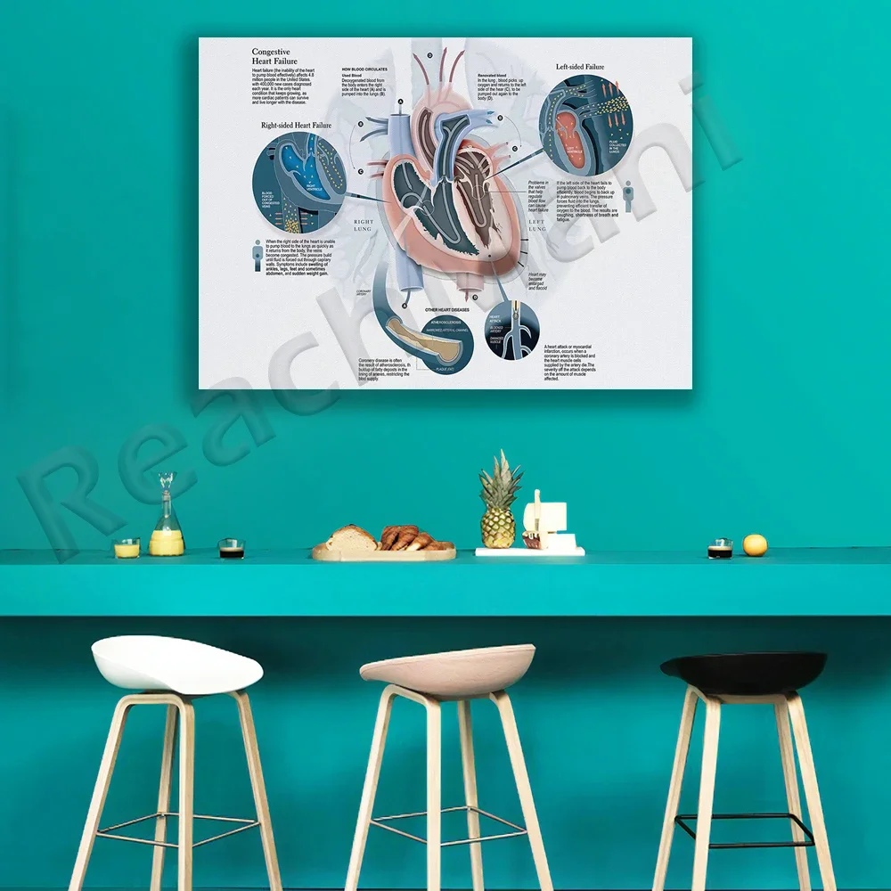 Congestive Heart Failure Horizontal Poster, Heart Failure Awareness Wall Art, Human Heart Medical Wall Decor, Cardiologist Gift