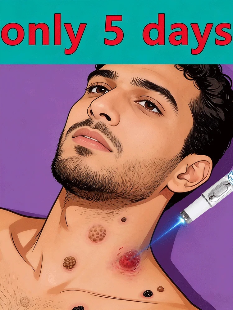 

Ручка-корректор для удаления бородавок за 7 дней – быстродействующее средство для лечения бородавок на лице, руках и ногах