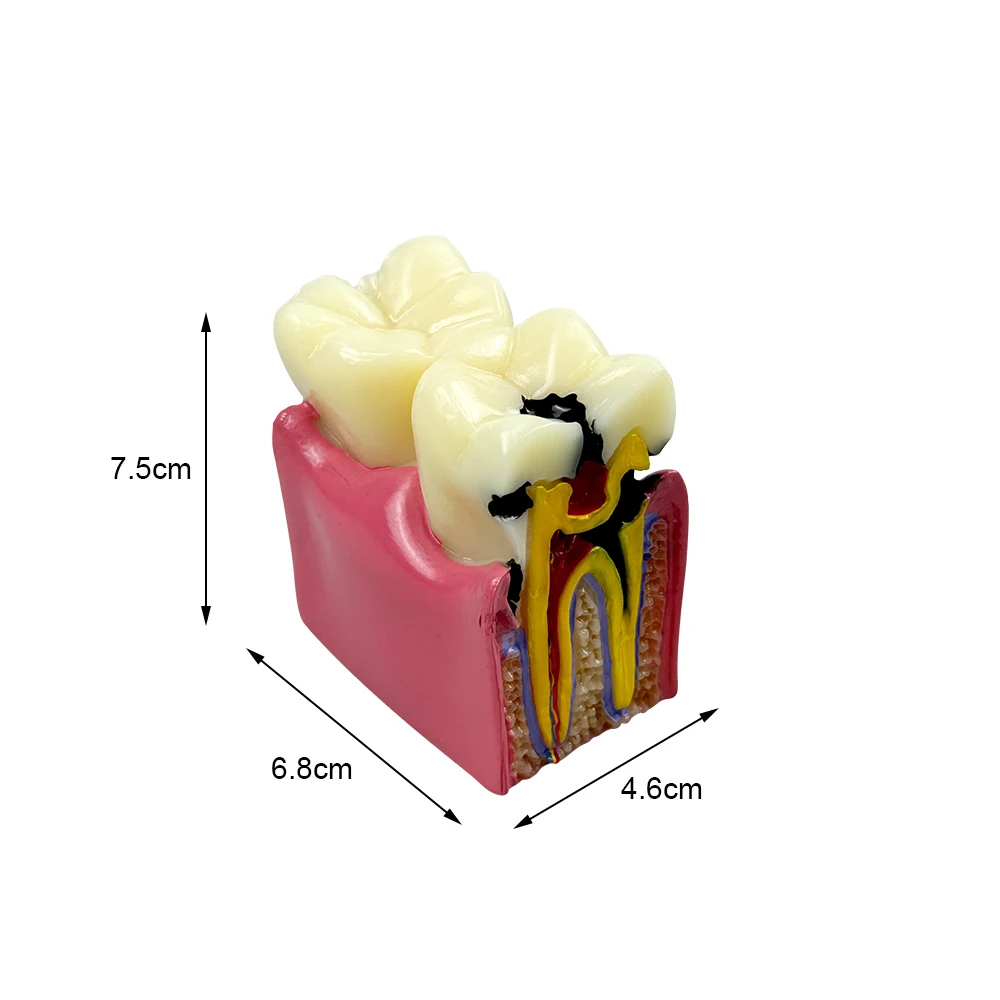 Dental Caries Comparsion Tooth Models 6 Times Study Models For Dentist Studying Teaching Anatomy Practice Dentistry Teeth Model
