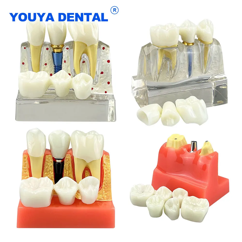 Teeth Model Dental 4 Times Analysis Crown Bridge Removable Teach Demonstration Model Dentist Study teaching clinic Gift