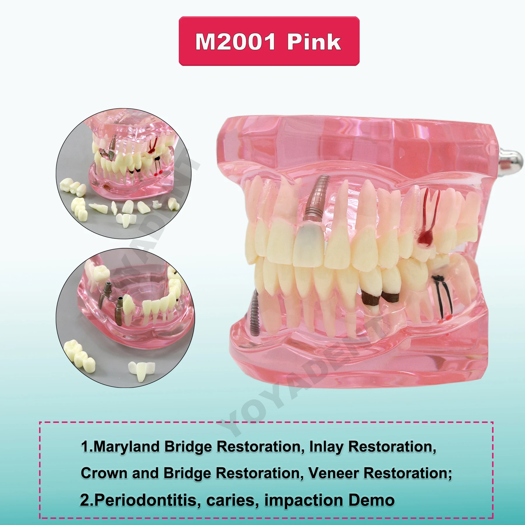 Multiple Types Dental Model Teeth Dental Teaching Models Study Orthodontic Removable Teeth Implant Models Dentist Material