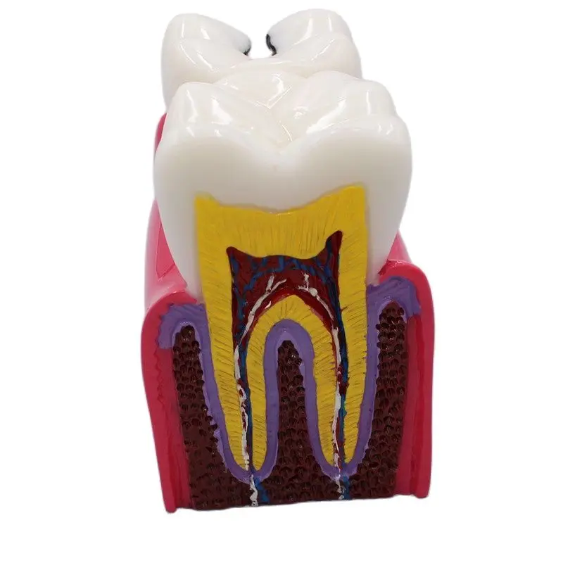 1PCS Dental Materials Lab Teeth Model 6 Times Caries Comparation Study Models For Dentist Studying and Researching