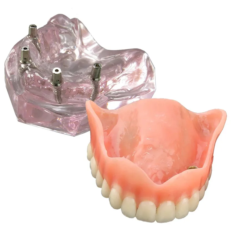 Dental Model Overdenture Upper Teeth 4 Implants Demo for Teaching and Studying