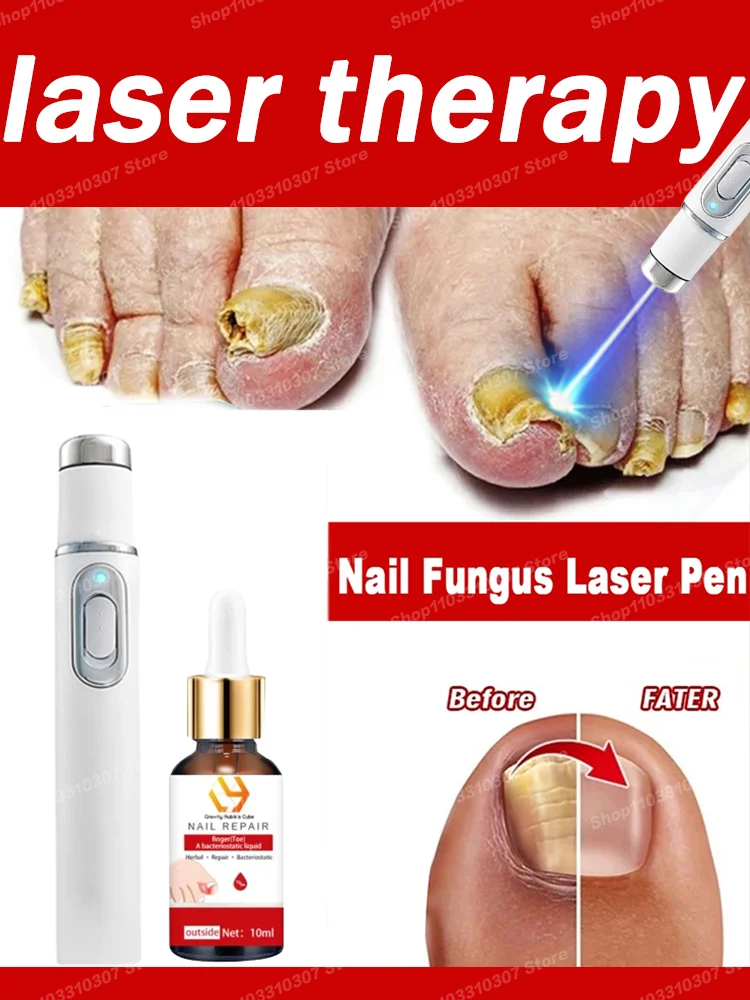 Dispositivo láser para uñas fúngicas, reparación rápida, antiinfección, paroniquia, onicomicosis, uñas encarnadas, cuidado de los pies