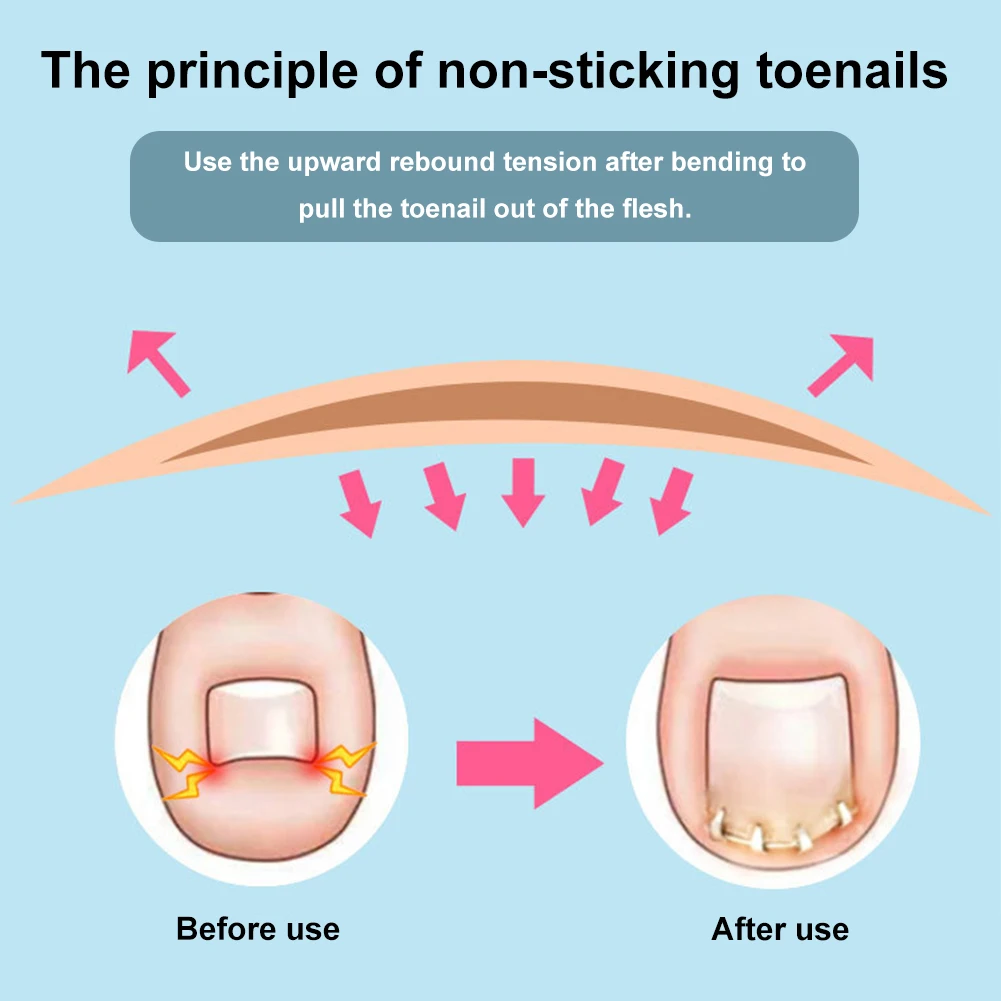 Ingrown Toenail Pedicure Tool Ingrown Toenail Correction Foot Care Tool Embed Toe Nail Care Straightening Correction Clip