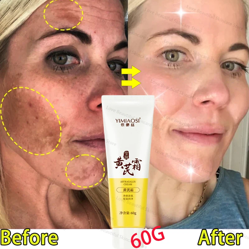 Astragalus Whitening Freckle Face Cream Remove Dark Spots Lighten Melanin Improve Dullness Moisturize Brightening Face Skin Care