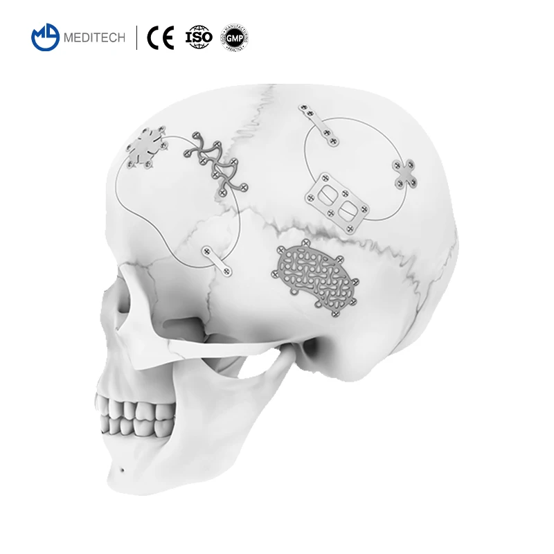 MEDITECH Orthopedic Surgical Maxillofacial Neurosurgery System Cranial Implant Titanium Mesh Plate for Skull Cranioplasty