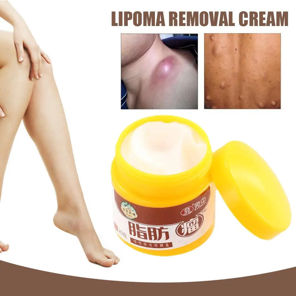 20G Lipoma Removal Cream The Whole Body Multiple Subcutaneous Conditioning Cream Eliminate Tumor Removal Ointment