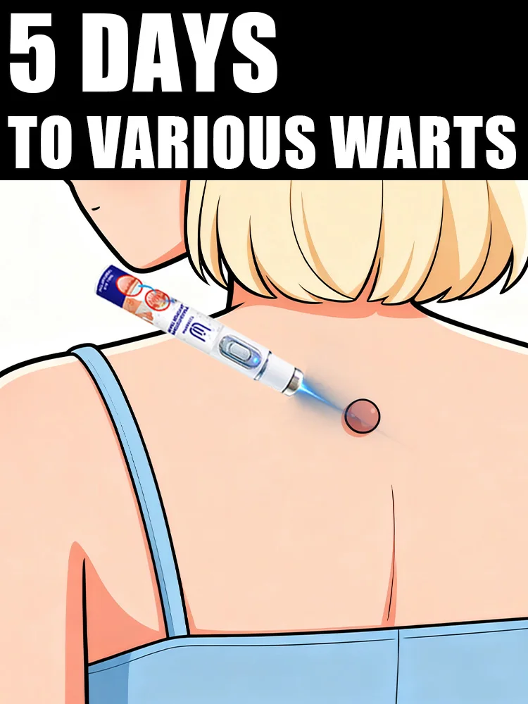 

2025 New Upgrade Blue Laser Solve Wart Tool