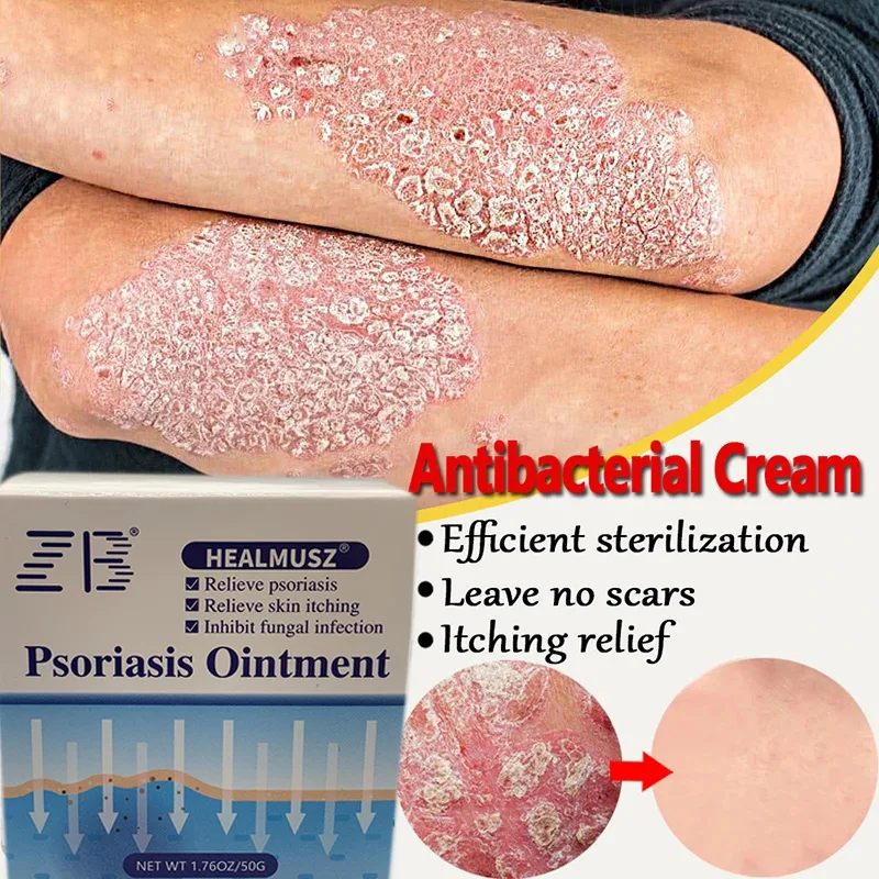 

10/20pcs 50g Psoriasis Cream Eczema Rash Urticaria Dry Skin Moisturizing Care Dermatitis Repair Treat Antibacterial Ointment