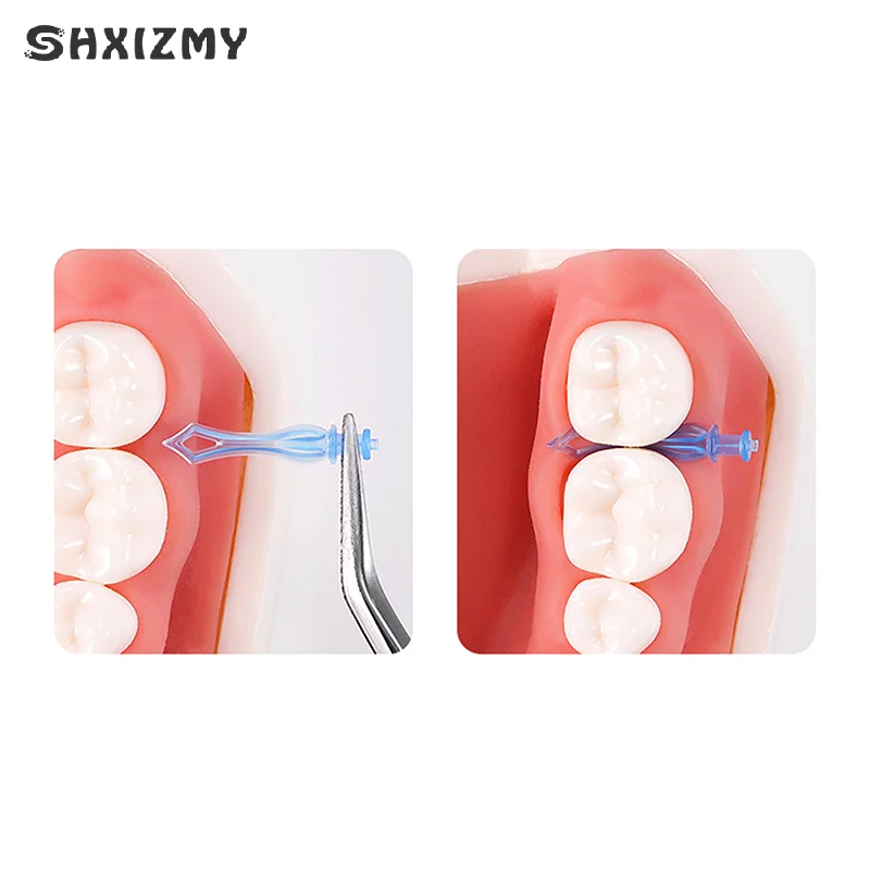 210 ชิ้น Dental Diamond Wedges พลาสติกทิ้ง Autoclavable ทันตกรรม Wedge Interdental ฟัน Gap Therapy อุปกรณ์เสริม