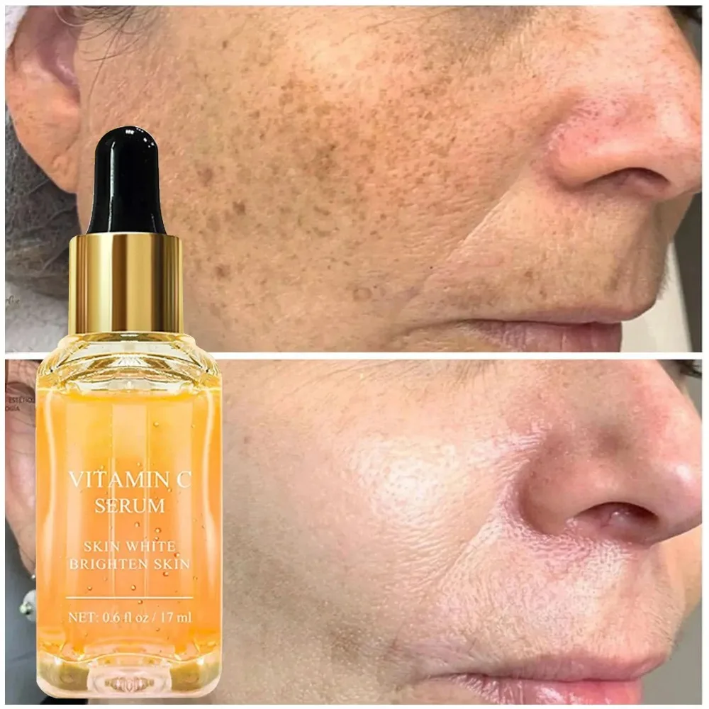 Rimuovere le macchie scure Siero viso sbiancante Lentiggine Dissolvenza Melanina Retinolo Essenza antirughe Schiarente Siero alla vitamina C Pelle