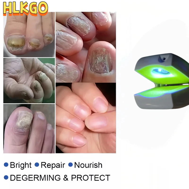 

Перезаряжаемое лазерное устройство грибка ногтей, 470 нм синий свет, 905 нм невидимый лазерный беспроводной связь для удобного ухода за ногтями в любом месте