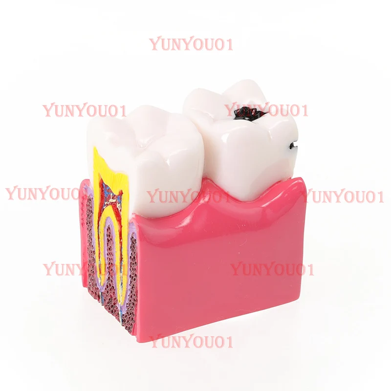 

Tooth Model 6x Caries Comparison Model