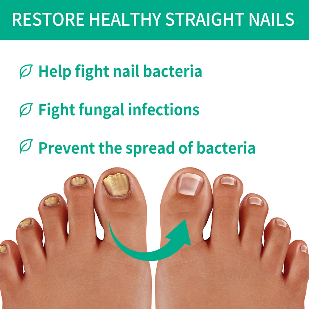 Extra Strong Nail Fungus Treatment Serum Essence Oil Feet Nails Repair Care Essence Cream Anti Infection Toe Fungal Removal Gel