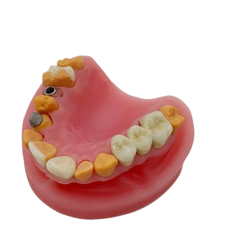 1PC Silicone Dental Restoration Mold Display Inlay Veneer Porcelain Bridge Dental Implant Abutment Model for Dental Lab Training