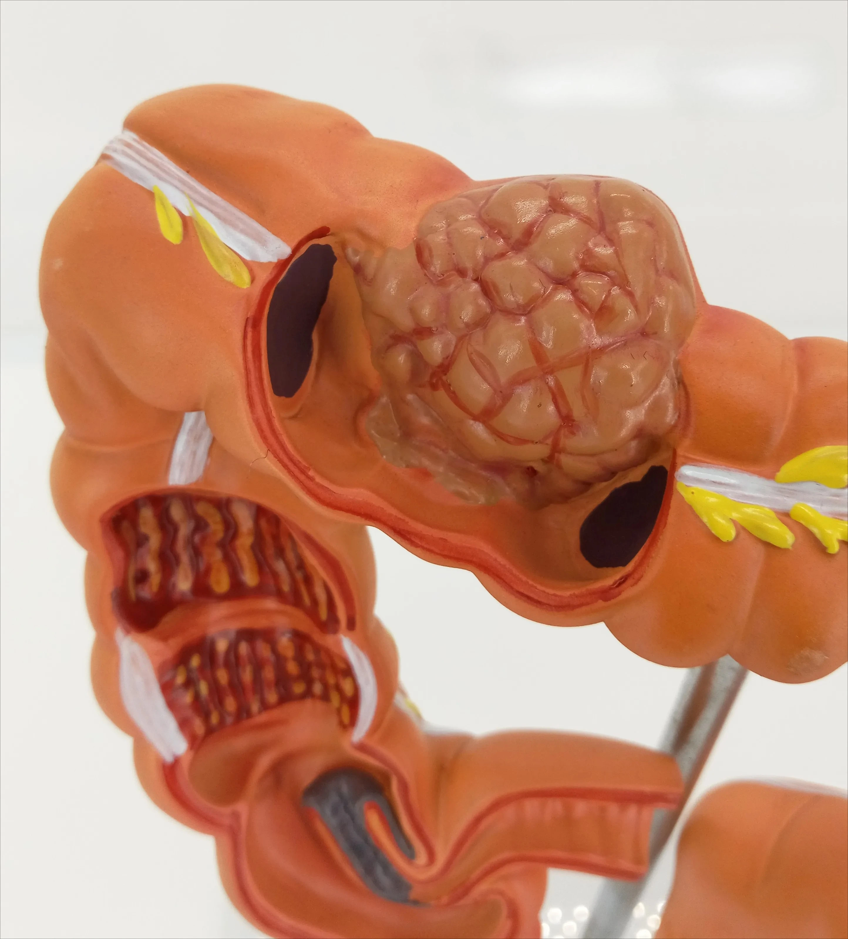 Colon pathological model Colorectal lesions specimens Intestinal anatomy model