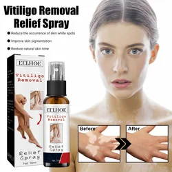 Vitiligo Treatment Relief Spray Skin Treatment White Spot Removal Vitiligo Eliminate Vitiligo External Moisturize Skin Care