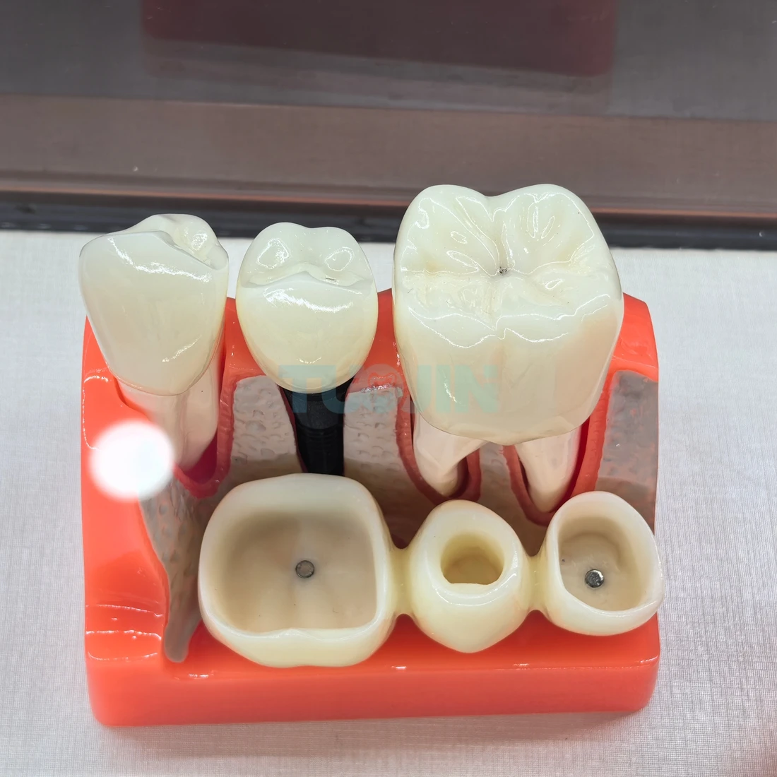 1Pcs Dental 4 Times Implant Teeth model Analysis Crown Bridge Demonstration Removable Model Dentist Teaching Training Model