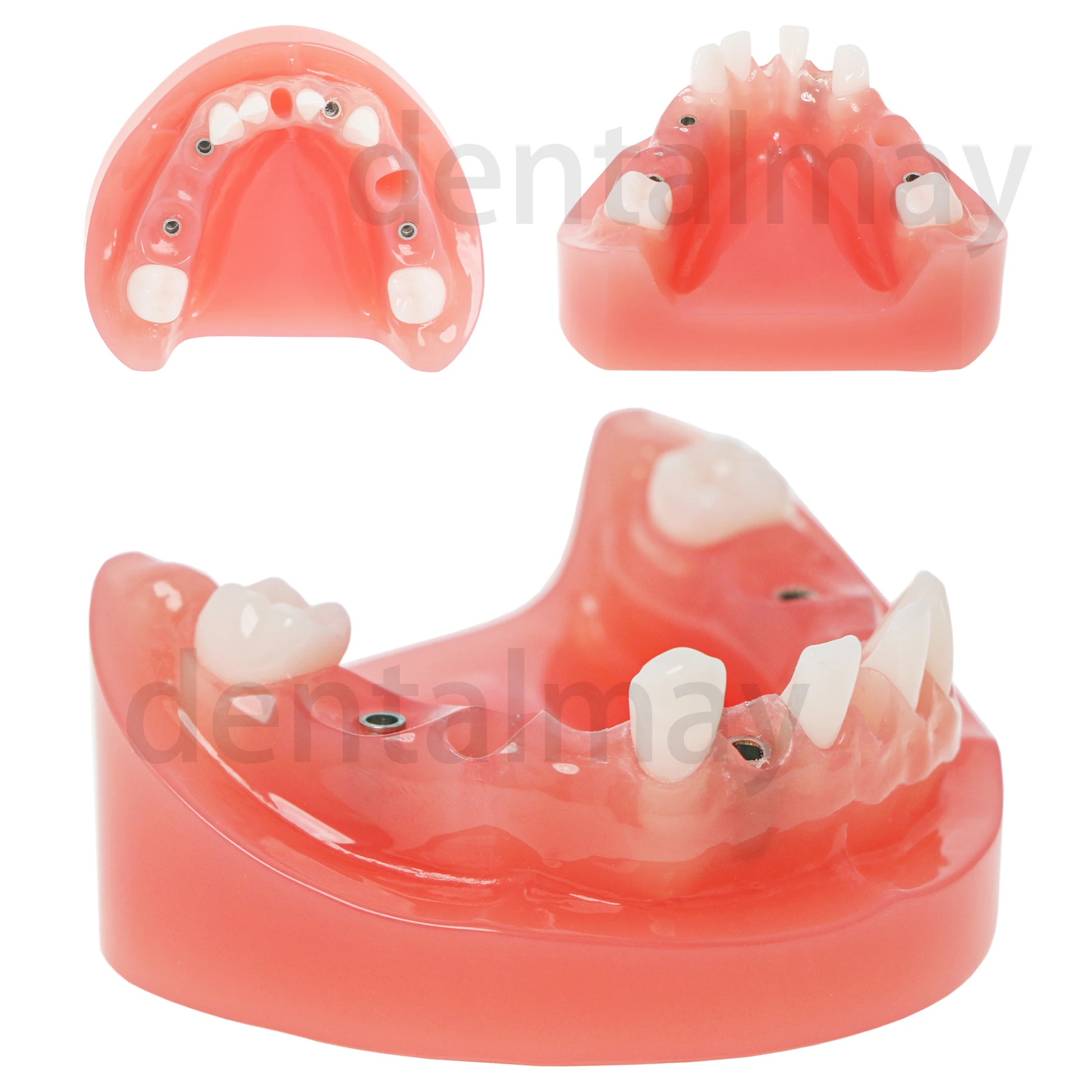 

Dental Typodont Teeth Model for Implant and Restpration with 4 Screws Implant Nails M6019