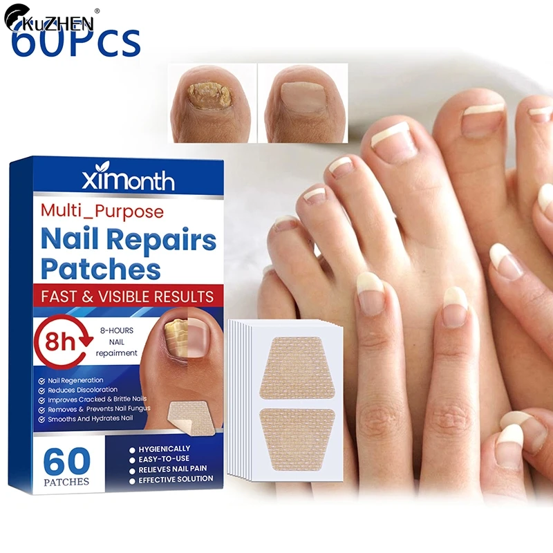 60Pcs Toenail Fungus Patch Sticky Nail Repair Patch Nail Ingrown Correction Sticker Toenail Care Paronychia Nail Treatment Patch