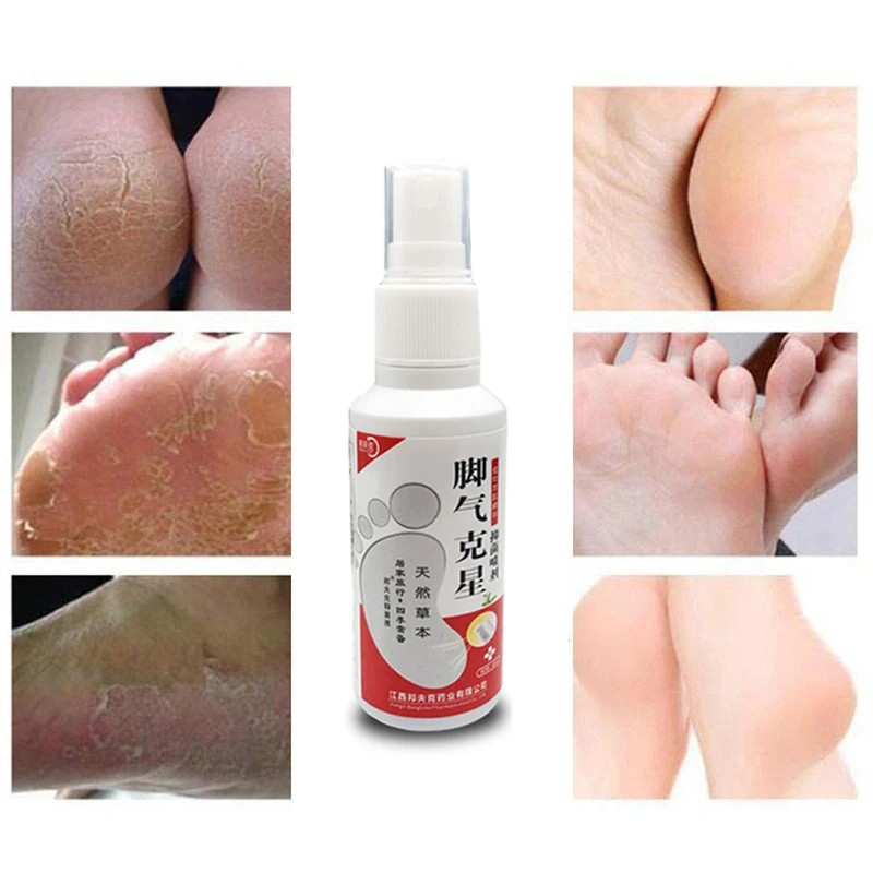 Spray Antibacterial Deodorant Powder Anti Itch Sweat Odor Feet Athletes Foot Liquid Anti-fungi Shoe Sock Feet Care