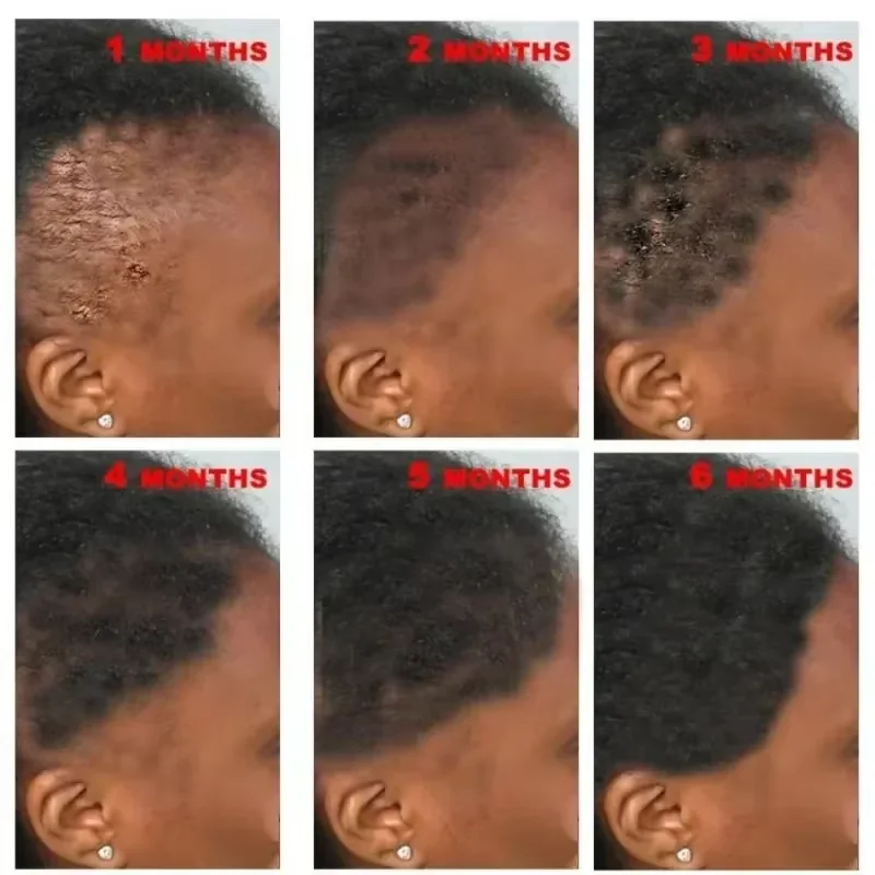 New Fast Hair Growth Serum African Crazy Regrowth Alopecia Anti Hair Loss Essential Oil Prevent Edge Bald Spot Thinnin Hair Care