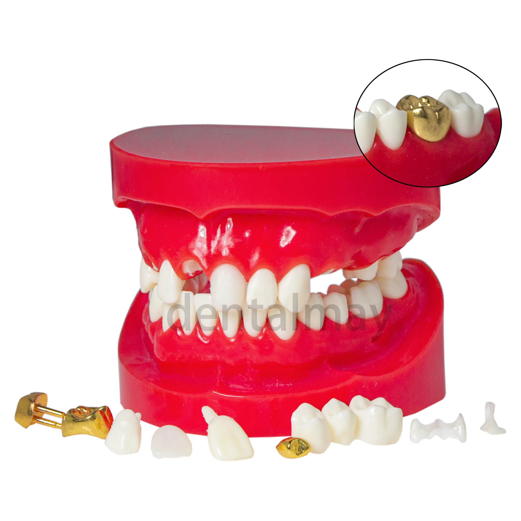 Dental Typodont Teeth Model M6004 Restoration Model Crown with Post Core Bridge