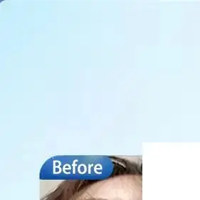 

Low Temperature Thermoplastic Nose Splint Nose Job Rhinoplasty Splint Ortho Immobilized Thermoplastic Nose Nasal Fracture Splint