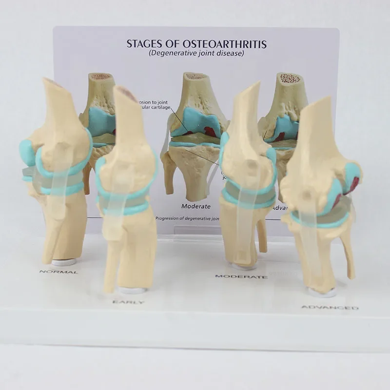 Knee Joint Model Set Human Body Anatomy 4-Stage Osteoarthritis Knee Joint for Doctors Office Educational Tool