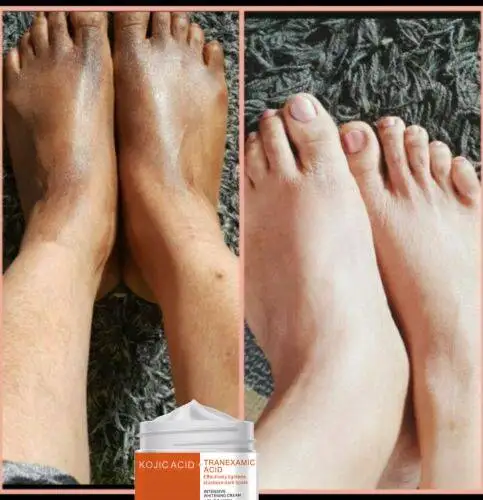 REAL Result Peeling Cream, Dark Knuckles Eraser Feet Whitening SUPER EFFECTIVE WORKS GREAT 100% Kojic Acid Cream