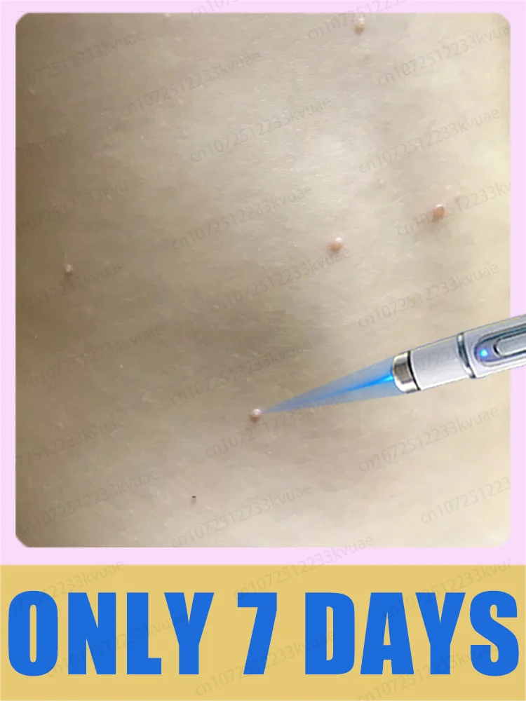 Generation-2 Laser Says Goodbye To all warts In 7 Days