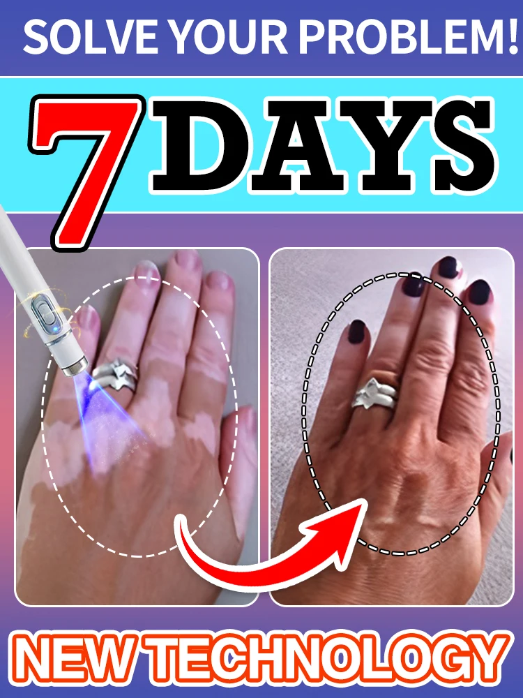 

Efficient laser technology to quickly improve vitiligo