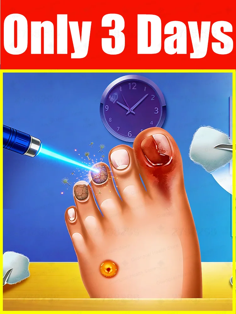 

Blue light laser pen ᵗʰᵒʳᵒᵘᵍʰˡʸ ʳᵉᵐᵒᵛᵉˢ ᶠᵘⁿᵍⁱ⸴ ᑫᵘⁱᶜᵏˡʸ ᵉˡⁱᵐⁱⁿᵃᵗᵉˢ ᶠᵘⁿᵍⁱ⸴and restores nail health.