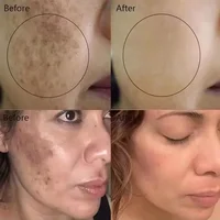 Crème blanchissante pour les imperfections, Niacinamide douce et puissante, éclaircit la mélanine, Pigment terne, Melasma, taches foncées, hydrate les soins coréens pour la peau 4