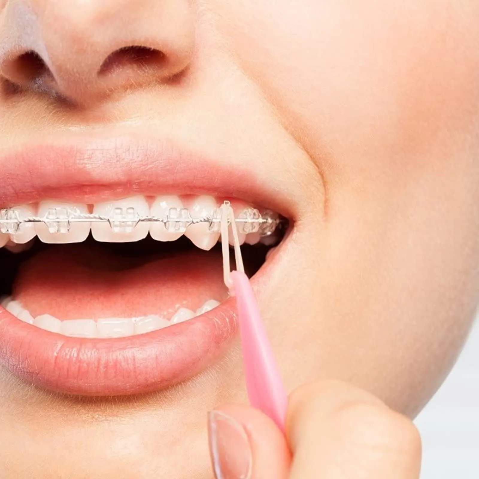 100 Pcs Rubber Bands For Teeth Care Teeth Elastics Braces Teeth Correcting Deformity 3.5 Oz 3/8