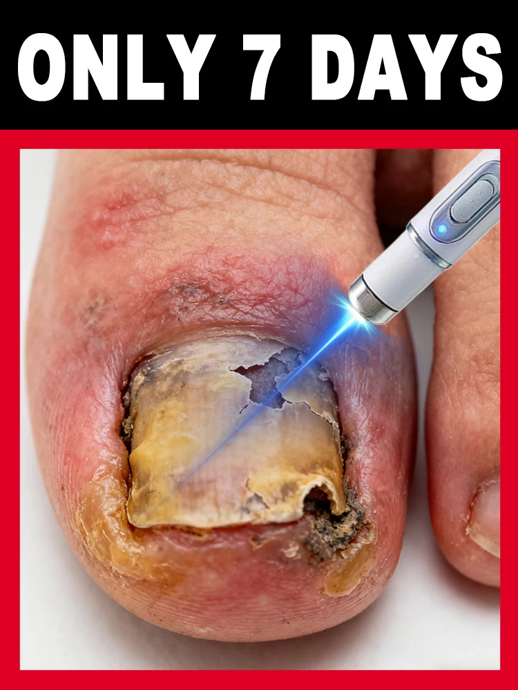 

Prevent onychomycosis from getting worse and ʳᵉᵈᵘᶜᵉ ᵗʰᵉ ʳⁱˢᵏ ᵒᶠ ᵇᵃᶜᵗᵉʳⁱᵃˡ ⁱⁿᶠᵉᶜᵗⁱᵒⁿ ᵒᶠ ᵗʰᵉ