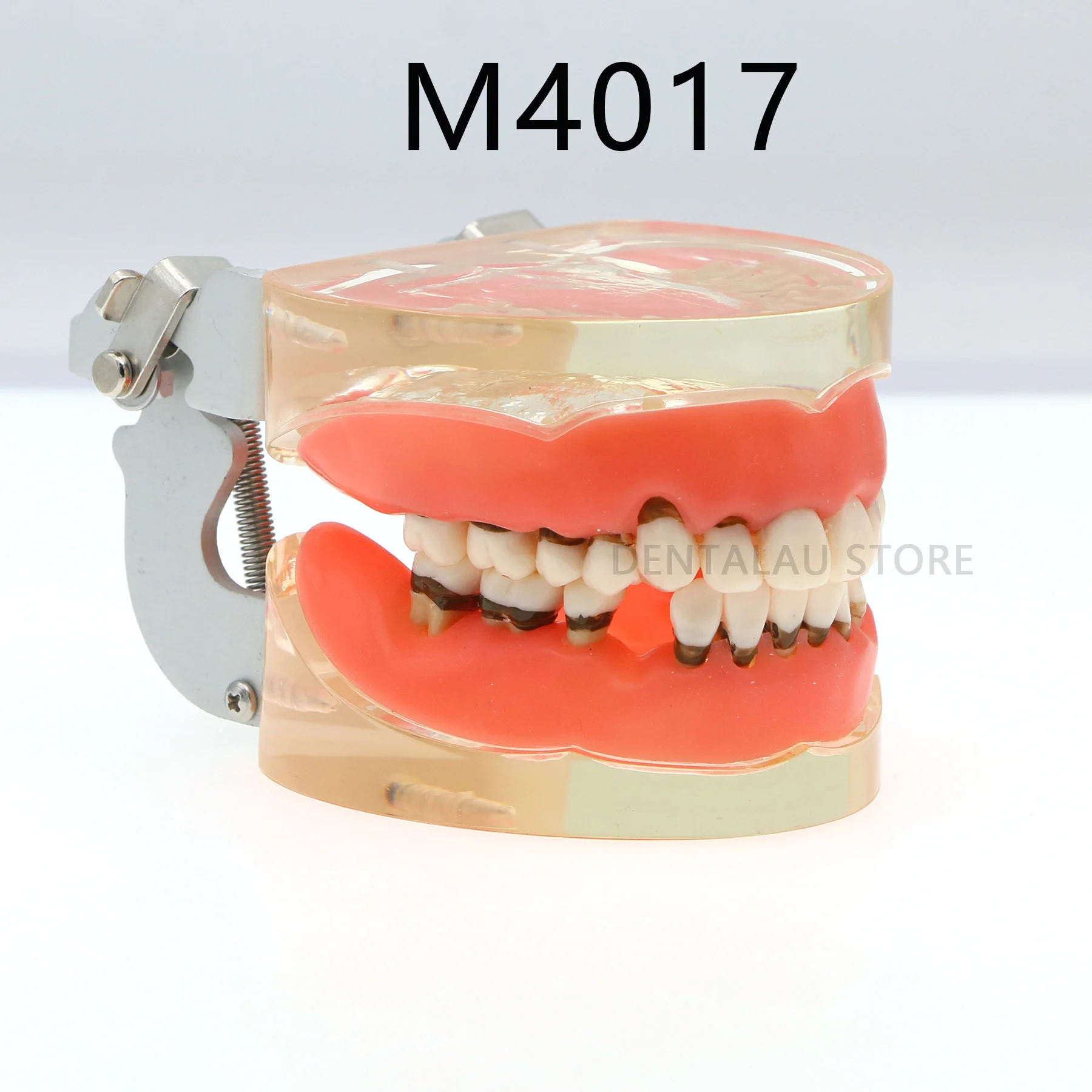 

Dental Teeth Model for Patient Education Demo Periodontal Disease Pathological FIT Model Demonstration Dentist Teaching M4017