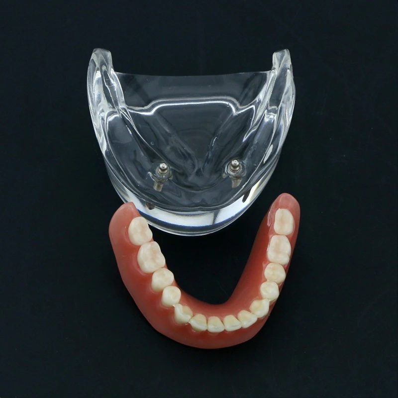 Model zębów dentystyczny z modelem Overdenture z implantem gorszy Model zębów demonstracyjny do badania dentysty Model nauczania stomatologiczne 2/4