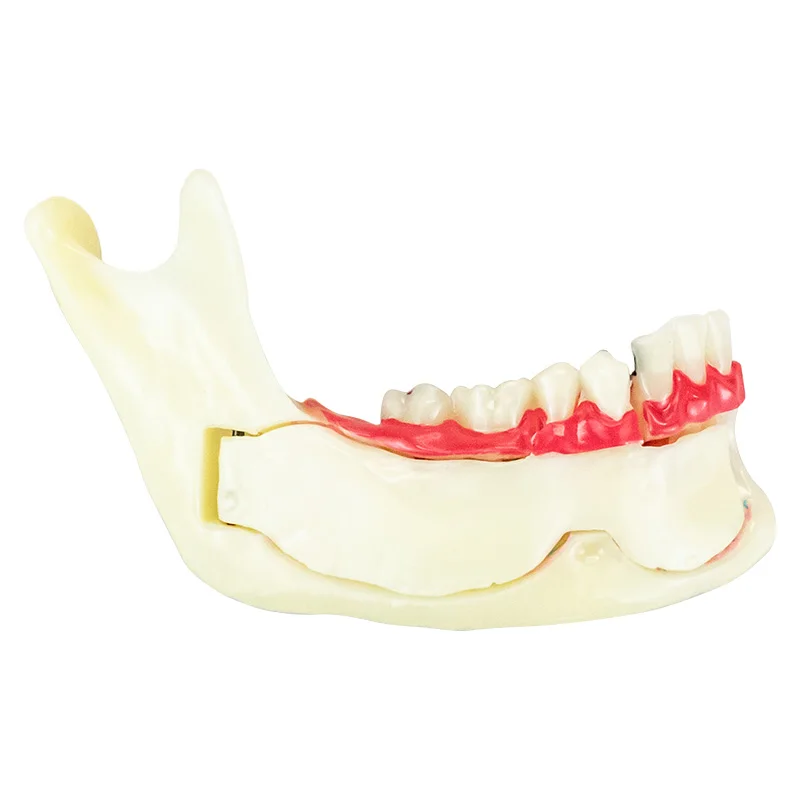 Dental Endodontic Treatment Model Anatomy of Gums Mandible Tissue Anatomical Model Dentist Teach Study Demonstration Teeth Model