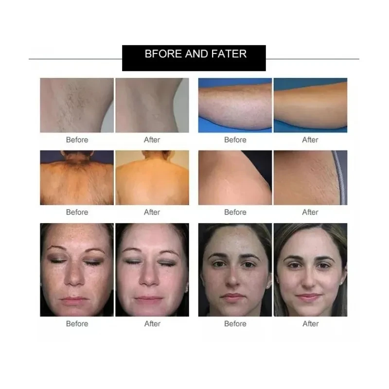 جهاز إزالة الشعر بليزر ديود من التيتانيوم الثلجي ، أداة تجميل ، نانومتر ، من من من من من من من من من من من من من من من من من ومن ومن ومن ومن ومن ومن ومن ومن ومن ومن ومن ومن ومن ومن ومن ومن ومن ومن ومن ومن ومن ومن ومن ومن ومن ومن ومن ومن ومن ومن ومن ومن ومن ومن ومن ومن ومن ومن ومن ومن ومن ومن ثم